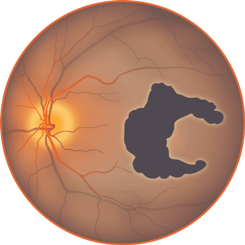 Illustration of an eyeball showing a GA lesion