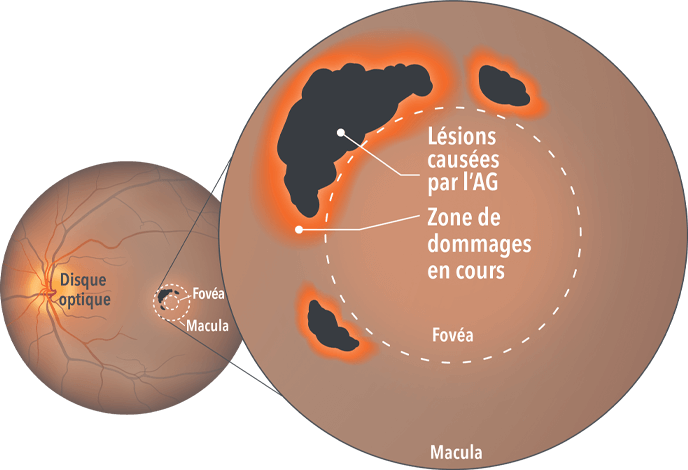 Image d’une macula avec des lésions d’AG