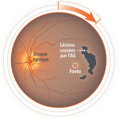 Image d’un diagramme du globe oculaire commenté montrant une lésion d’AG – disque optique, lésion causée par l’AG, fovéa