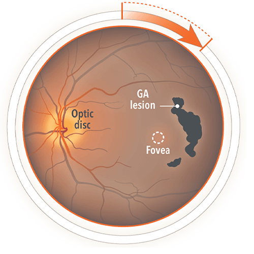 Image of labelled eyeball diagram showing GA lesion - Optic disc, GA leasion, Fovea