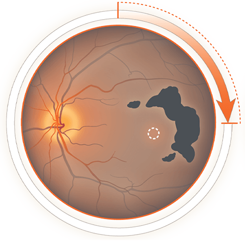 Image d’un diagramme du globe oculaire commenté montrant une lésion d’AG – disque optique, lésion causée par l’AG, fovéa