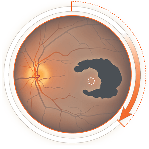 Image d’un diagramme du globe oculaire commenté montrant une lésion d’AG – disque optique, lésion causée par l’AG, fovéa