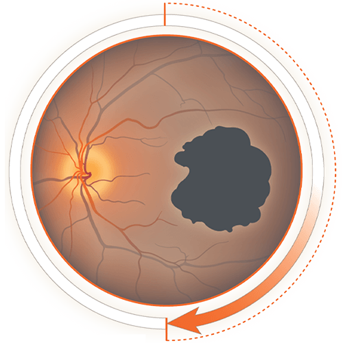 Image of labelled eyeball diagram showing GA lesion - Optic disc, GA leasion, Fovea