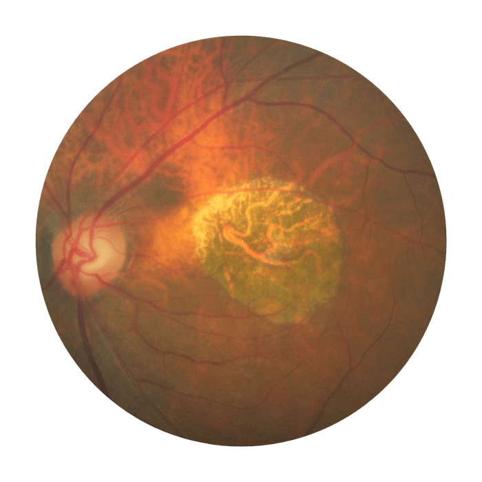 Colour fundus photograph of an eye with GA